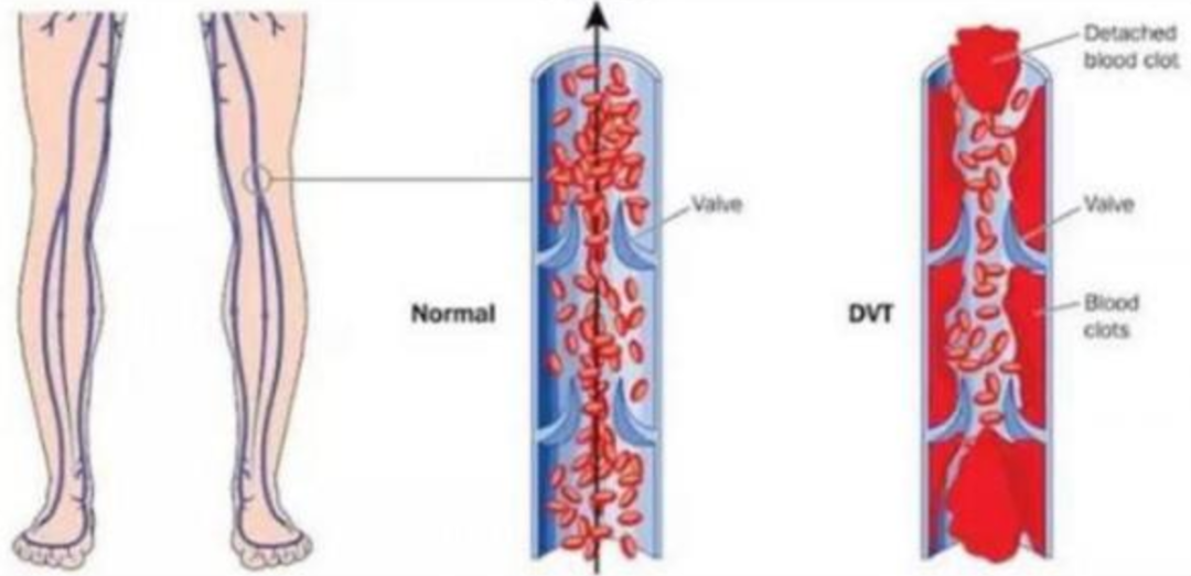 图右为产生血栓后的小腿静脉