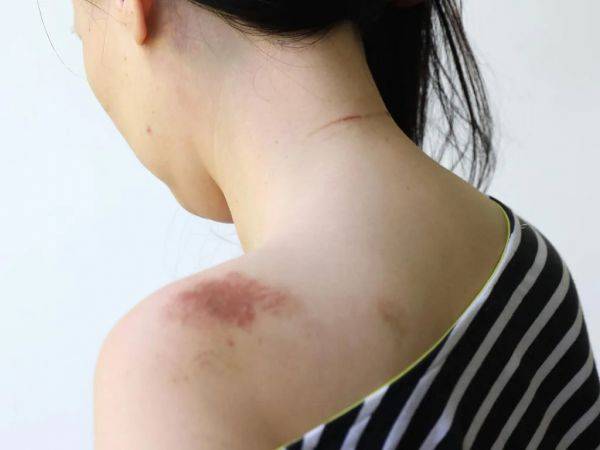 来自brookvale的女子在斗殴中受伤(图片来源:《每日电讯报》)
